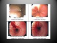 /album/esofagitis-eosinofilica/diapositiva10-jpg/